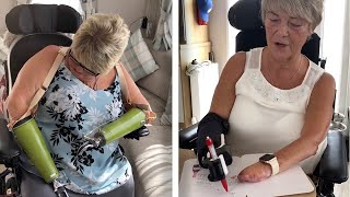 Sepsis Survivor With Amputated Limbs Spreads Awareness [upl. by Peltz576]