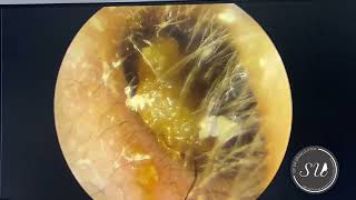 Endoscopic extraction of giant earwax by Dr Uluyol  Endoskopik kulak kiri çıkarılması [upl. by Burkhardt738]