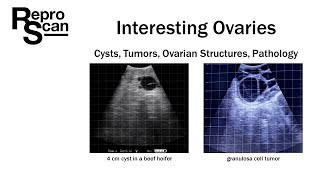 Interesting Ovaries  At look at cysts tumors ovarian structures and pathology [upl. by Greenwood]