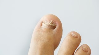 How to prevent and treat nail fungus [upl. by Apthorp99]