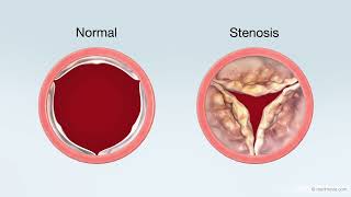 Transcatheter Aortic Valve Replacement TAVR Treatment for Aortic Stenosis [upl. by Shani]