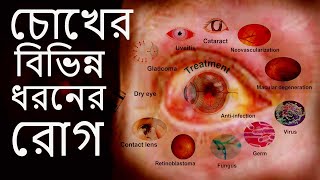 চোখের বিভিন্ন ধরনের রোগ এবং তাদের লক্ষণ16 type of Eye Diseases [upl. by Ciryl395]