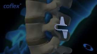 coflex® NonFusion Implant in Flexion and Extension  Paradigm Spine [upl. by Aklim]