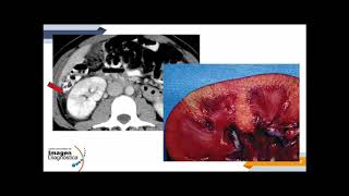 Pielonefritis Aguda Vs Crónica [upl. by Ileek645]