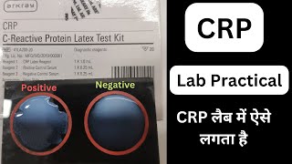 CRP Test Procedure in Hindi  CReactive Protein  Latex Test Procedure labtechnician mlt dmlt [upl. by Kina]