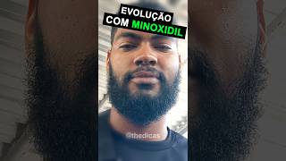 RESULTADO COM MINOXIDIL espetacular barba minoxidil thedicas [upl. by Samson]