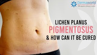 How to cure Lichen Planus Pigmentosus  Lichen Planus Pigmentosus Treatment  Dr Rohit Batra [upl. by Nilved]