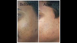 Tan skin or pigmented skin try our detan treatment smaavins vadapalani cosmetic call 9962234451 [upl. by Aseek]