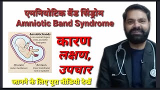 एमनियोटिक बैंड सिंड्रोम  Amniotic Band Syndrome cause symptoms and treatment in Hindi [upl. by Lleinnad63]