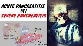 ACUTE PANCREATITIS  SEVERE NECROTIZING PANCREATITIS [upl. by Uzzi]