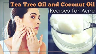 Tea Tree Oil and Coconut Oil for Acne How to Use [upl. by Iznek]