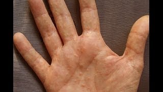 Dermatitis or Dyshidrosis How I Prevent Getting Painful And Unsightly Summer Hands [upl. by Iruam689]