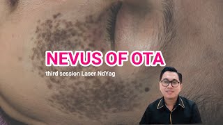 Nevus of Ota Punya Tanda Lahir Ini [upl. by Solegnave803]