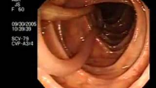 Parasites  Round Worm Found in Human Colon [upl. by Neehar]