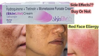 Hydroquinone Tretinoin Mometasone Furoate cream Honest Review l Benefits l Side Effects ll [upl. by Ahsennod]