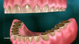 Teeth Grinding [upl. by Blodget]