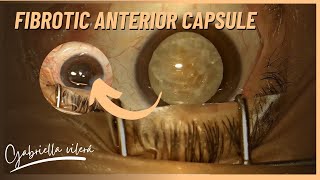 •Fibrotic Anterior Capsule [upl. by Lars507]