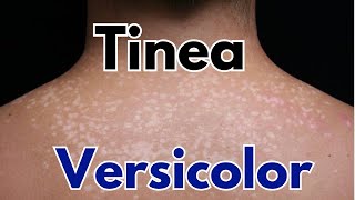 Tinea versicolor symptoms treatment  how to get rid of tinea versicolor [upl. by Pruter964]