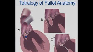 Mayo Clinic – Tetralogy of Fallot [upl. by Charissa476]