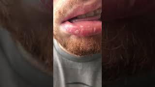 Exfoliative Cheilitis  Dovonex amp Elidel Treatment Results [upl. by Base]