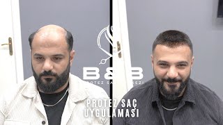 PROTEZ SAÇ UYGULAMASI  PROTEZ SAÇTA KISA SAÇ [upl. by Taima]