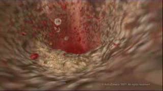 MEDICAL  How cholesterol clogs your arteries atherosclerosis [upl. by Vincent]