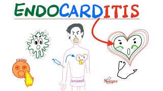 Infective Endocarditis  Fever amp New Murmur  Modified Duke’s Criteria  Cardiology Playlist [upl. by Nairret701]