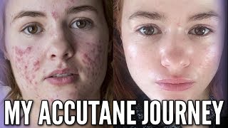 My Accutane Journey with Progress Photos and Relapse Experience [upl. by Maer]