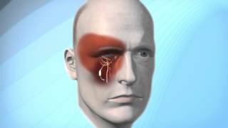 Pulsante Microstimulator for Cluster Headache [upl. by Enyrat]