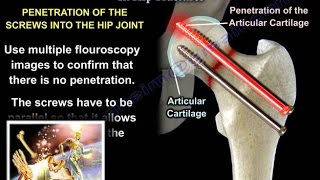 Fracture Healing  Everything You Need To Know  Dr Nabil Ebraheim [upl. by Clarisse]