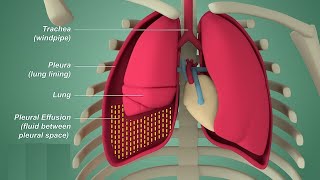 Pleural effusion  Internal medicine Etiology Clinical Features Diagnosis and Treatment Usmle [upl. by Eirised164]