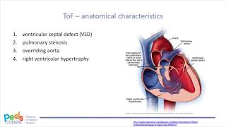 Tetralogy of Fallot [upl. by Afatsum]