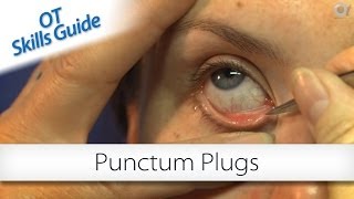 OT skills guide punctum plugs [upl. by Ginny470]