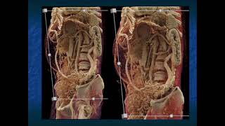 Gastric GIST Tumors Pearls and Pitfalls  Part 3 [upl. by Tijnar]