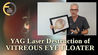 Eye Floaters Destruction in Single Painless Treatment  YAG Laser [upl. by Strander]