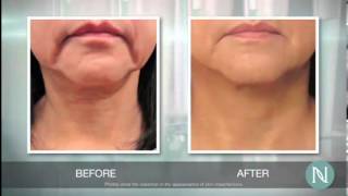 Eliminate Enlarged Pores  How To Reduce Pore Size Quickly  Watch This [upl. by Festatus]