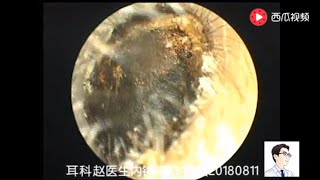 Ear endoscope cleaning the external auditory canal and answering common questions [upl. by Philbert630]