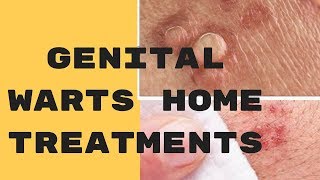 Genital Warts Home Treatments [upl. by Temple]