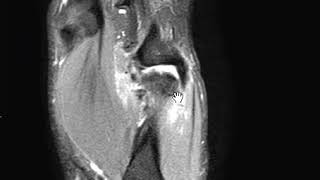 Stener Lesion [upl. by Eimas]