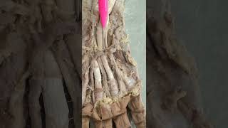 superficial palmar arch  Palmar arterial arch Ulnar artery  Radial artery common digital artery [upl. by Sholeen]