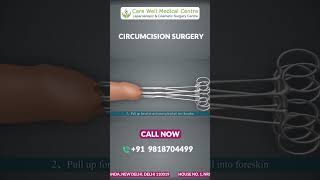 ZSR Circumcision Surgery in Delhi A StepbyStep Animated Guide  Circumcision Surgery Cost shorts [upl. by Somisareg]