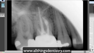 Endodontic Perforation  Hints to help you when it happens to you [upl. by Gambell8]