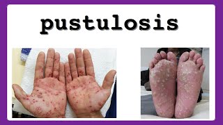 pustulosis [upl. by Esila]