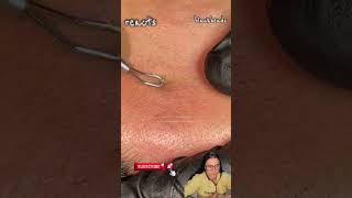 blackheads nose blackheads removal satisfying blackheads removal lips blackheads removal ear [upl. by Chipman784]