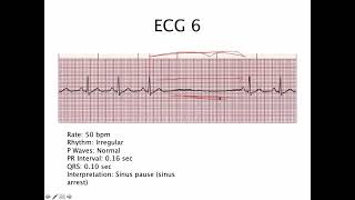 19 EKG rhythm practice 02  ការរៀនអានECG ចង្វាក់បេះដូងលោតមិនទៀងទាត់ 02 [upl. by Ilrahs107]