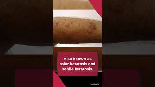 9 Tested Actinic Keratosis Natural Treatments [upl. by Neelya]