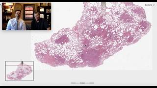 Pattern 5  Nodular Pulmonary Langerhans Cell Histiocytosis [upl. by Eninnaej151]