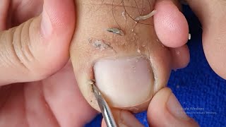 PEDICURE OF A MALE TOENAILS TUTORIAL  REMOVING INGROWN IN TOENAILS  SATISFYING VIDEO [upl. by Lemak]