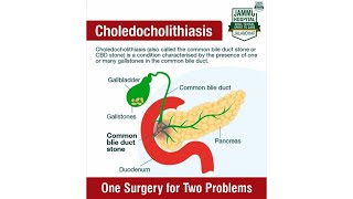 One Surgery for Two Procedures  Laparoscopic Cholecystectomy with Choledocholithotomy  Dr GS Jammu [upl. by Birgit]