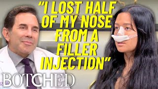 NonSurgical Nose Job Nightmare Melissa Lost Half Her Nose  Botched  E [upl. by Godderd]